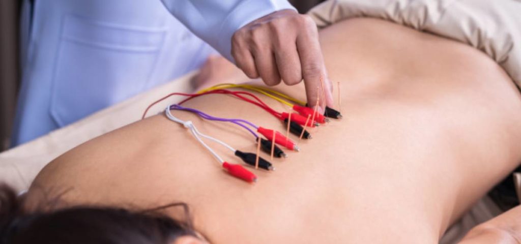 electroacupuncture